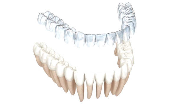 无牙套或隐形固位体可以进行咬合矫正。医学精准3D动画视频下载