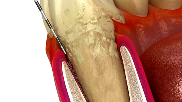 牙周炎测试，牙龈衰退过程。医学精准3D动画视频素材