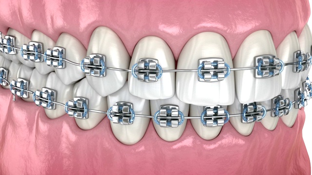 牙齿位置异常，用金属支架矫正。医学精确牙科3D动画视频下载