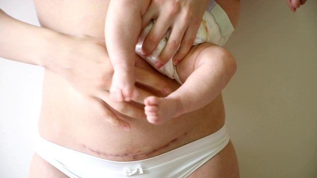 特写的妇女腹部疤痕从剖腹产。手上抱着婴儿的女人视频素材