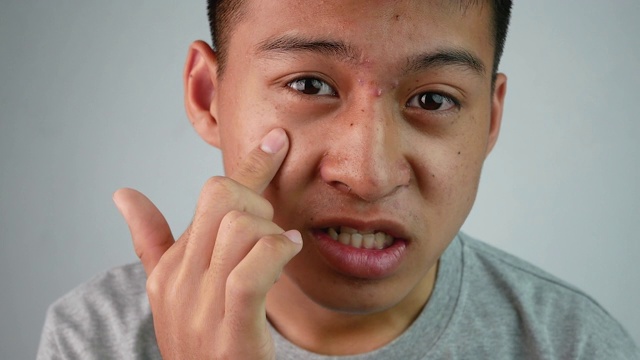 近距离面对亚洲少年与痤疮和问题皮肤。健康护肤理念。视频下载