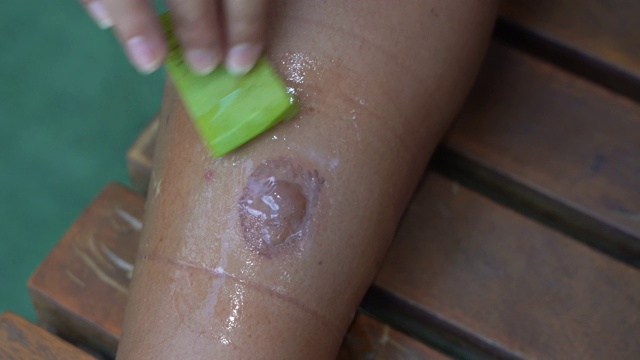 年轻女子正在治疗一个芦荟烧伤的伤口，小腿上的皮肤烧伤视频素材