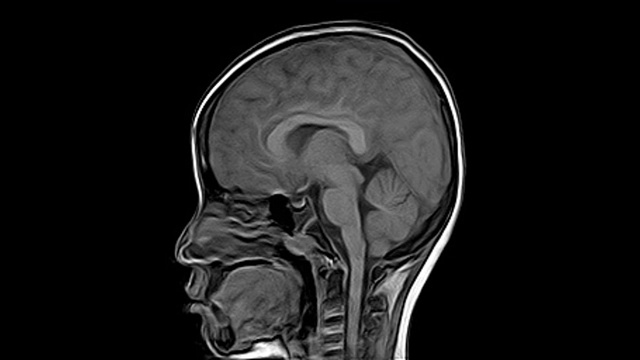 脑MRI: 8岁男孩病史:头痛3天。发现大面积急性脑实质出血，以白质为中心，轻度累及皮质。视频下载
