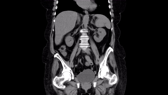 腹腔，胃肠道，膀胱的MRI检查视频素材