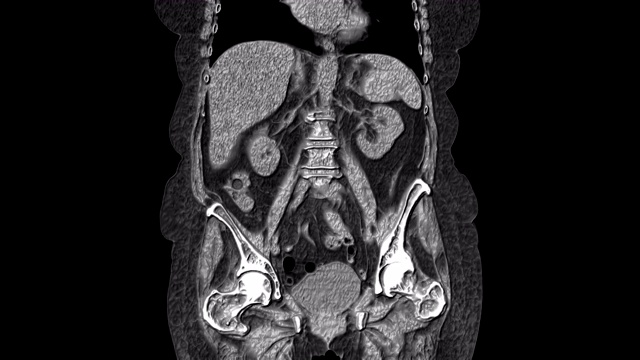 大量MRI显示腹腔，胃肠道，膀胱视频素材