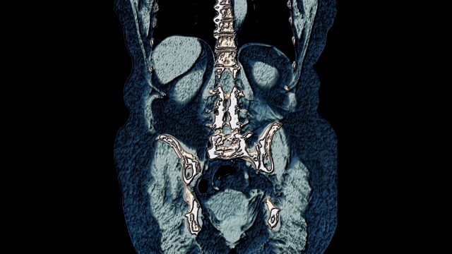 大量彩色MRI显示腹腔，胃肠道，膀胱视频素材