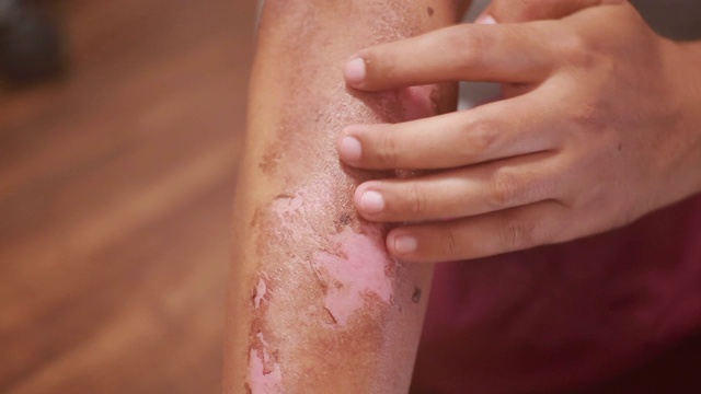 女性抓挠干燥的片状皮肤。视频素材