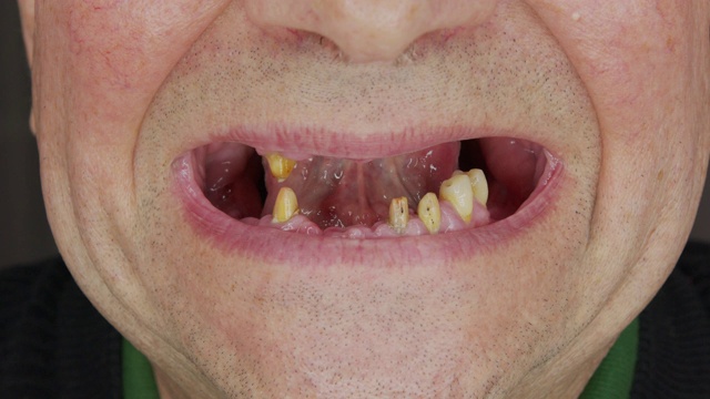 一个男人露出他腐烂的牙齿。特写一个没有牙齿的老人的嘴。视频下载