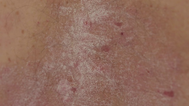 银屑病:一个男人的近距离运行他的手在银屑病皮疹斑块和伤口视频素材