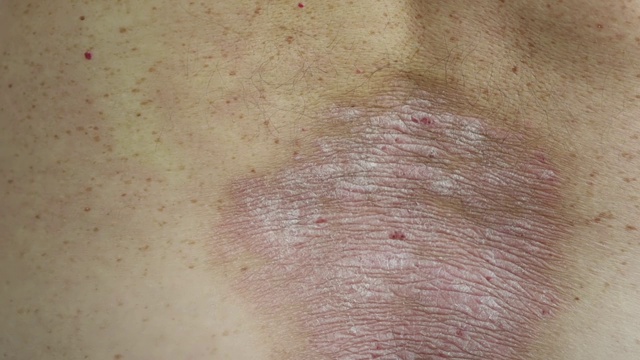 牛皮癣:一名男子用手抚摸背部受牛皮癣皮疹和斑块影响的区域的特写视频下载