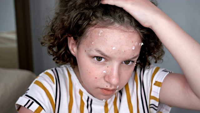 十几岁的女孩用某种乳霜来润滑痤疮。自我治疗的危险视频素材