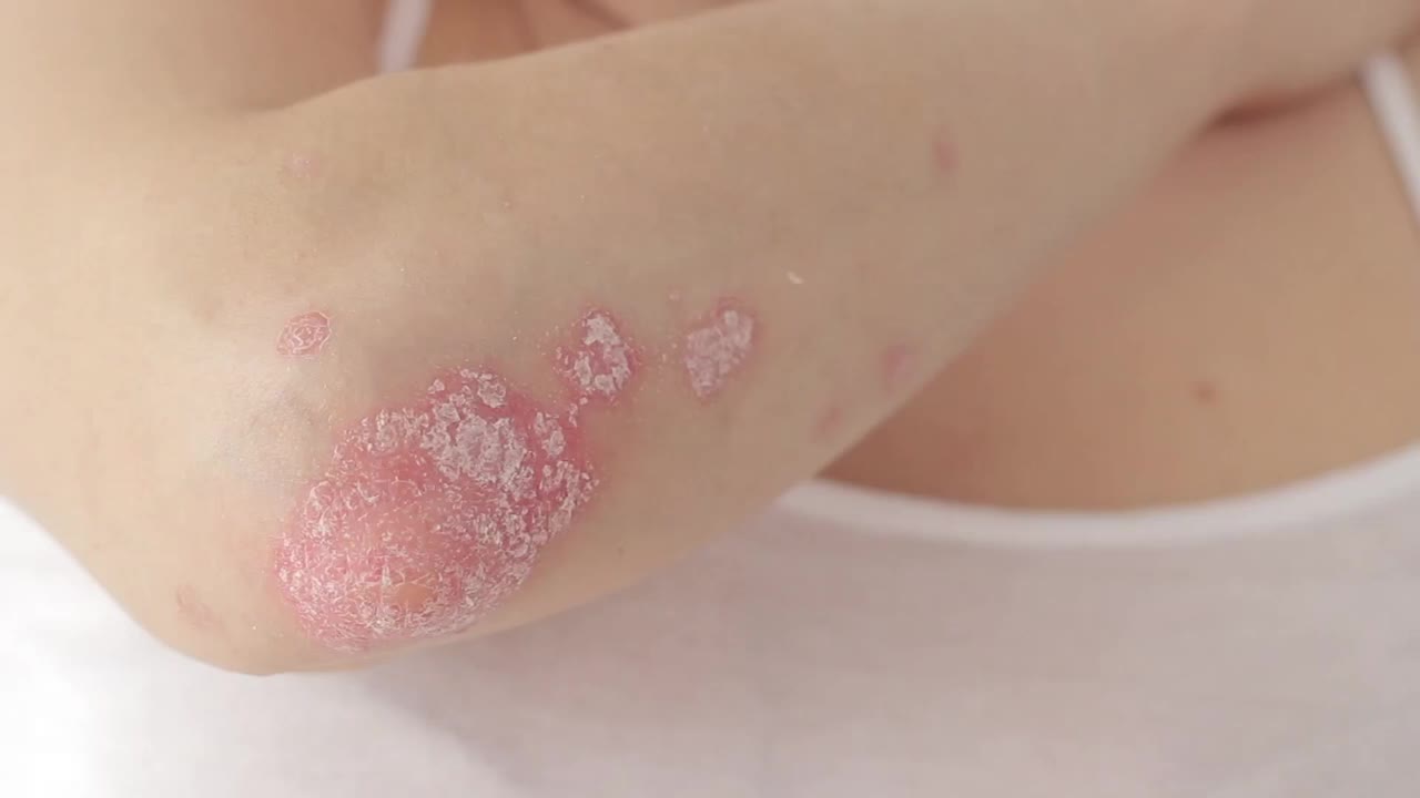 女性用手抓挠肘部的急性牛皮癣，这是一种自身免疫性的不可治愈的皮肤病视频素材