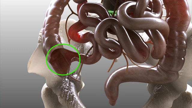 3D医学动画-盲肠和附录视频素材