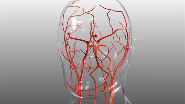 3D医学动画-脑动脉瘤线圈栓塞术视频素材