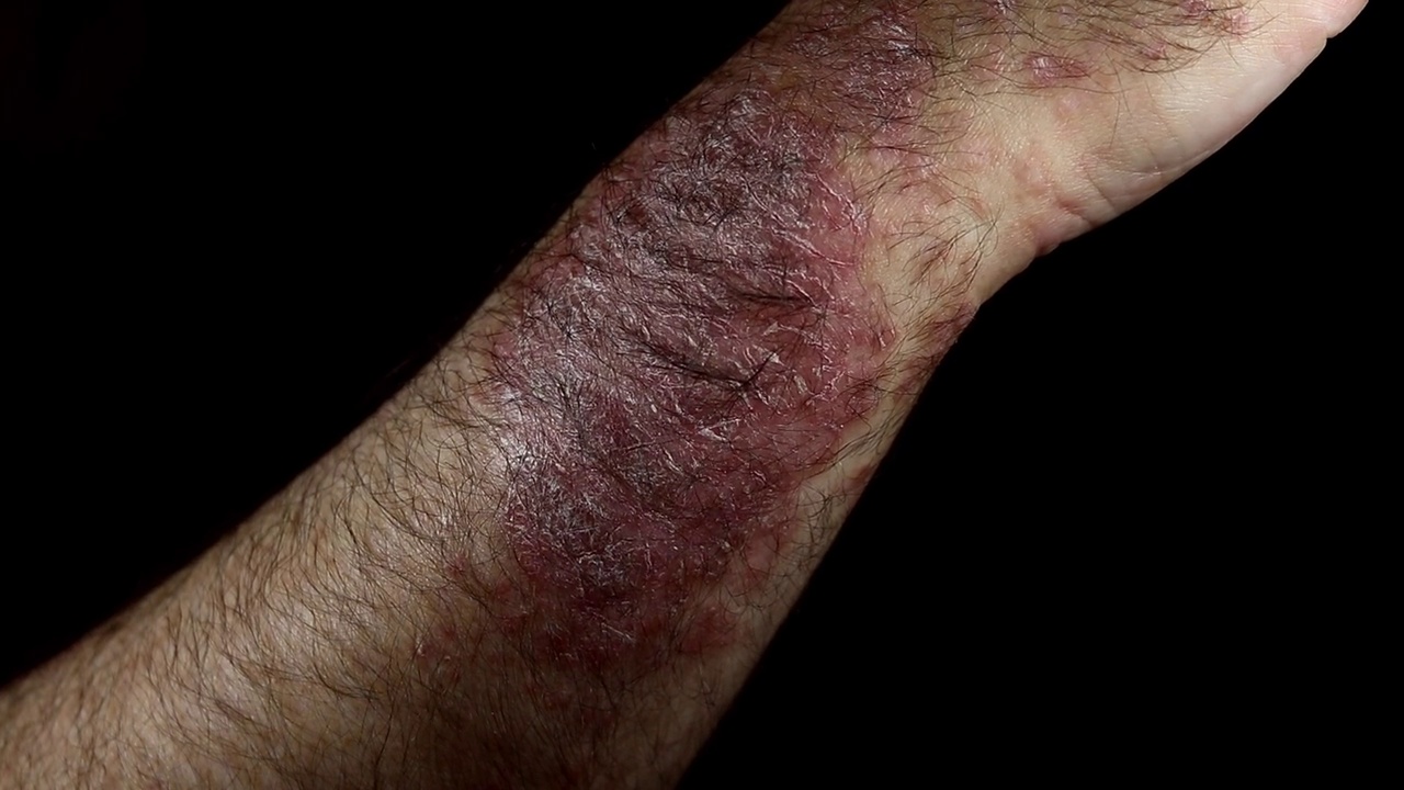 手臂上的牛皮癣(湿疹)男子皮肤发痒，黑色背景上的牛皮癣视频下载