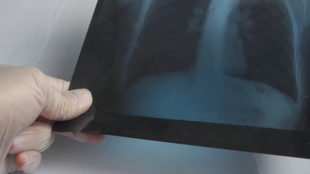 医生戴着防护手套拍下肺部x光片。新型冠状病毒(COVID-19)肺炎检测。医生检查。视频下载