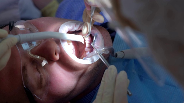 牙科医生用超声波清洗牙齿的病人。视频素材
