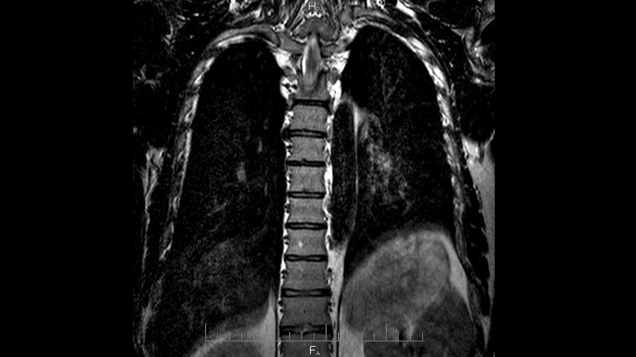 脊柱和肺的核磁共振扫描，背部和骨骼的核磁共振成像特写，时间推移视频下载