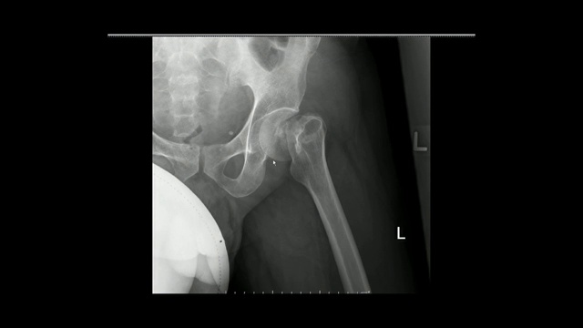 骨盆X光片显示左股骨颈骨折(骨盆X光片)。视频素材