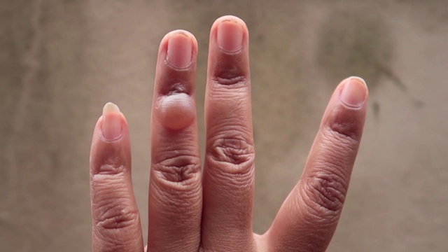 左手手指有无名指被开水烫伤的伤口视频下载