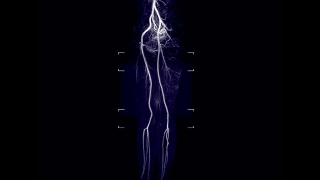 主动脉、髂和股动脉的磁共振血管造影或MRA的MIP技术图像。视频下载