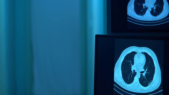 放射科门诊电脑显示器上冠状病毒阳性患者胸部CT图像4K视频视频素材