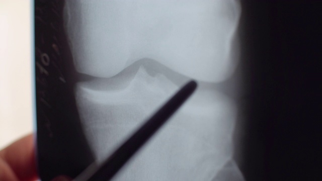 x射线的膝盖视频素材