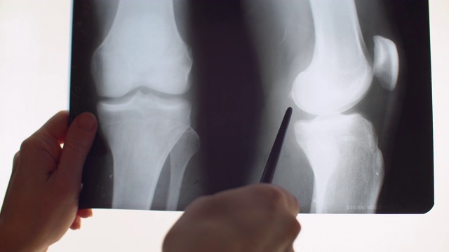 x射线的膝盖视频素材