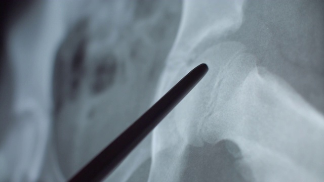 骨盆的x射线视频素材