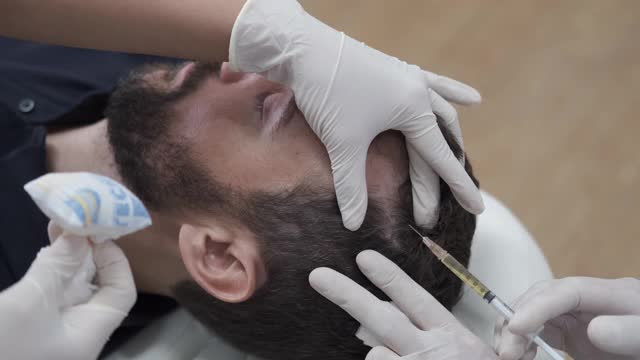 头发中膜疗法或头皮prp:富血小板血浆疗法。美容师在男子头部注射以促进头发生长，防止脱发和秃顶视频素材