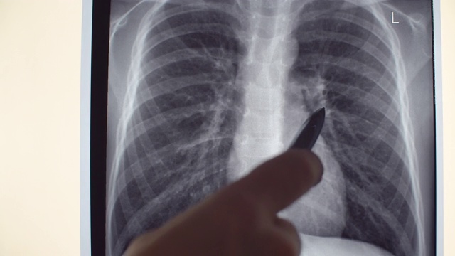 x射线的肺视频素材