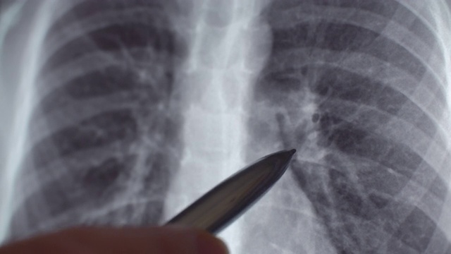 x射线的肺视频素材