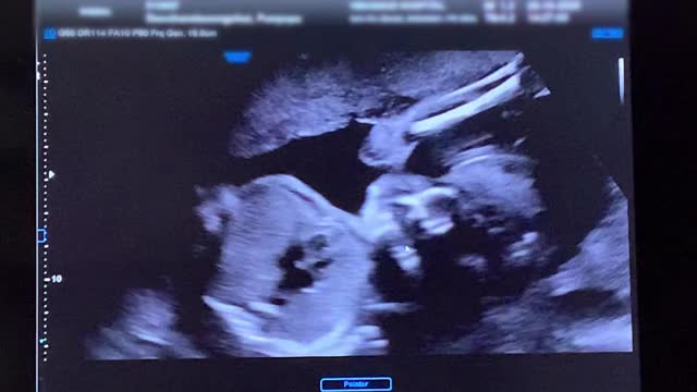 孕妇胎儿的超声扫描。视频下载