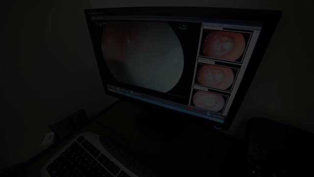 医生使用医疗器械和摄像机来进行腹部手术视频下载