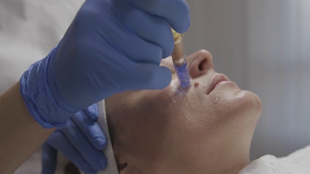 美容师在一个女人的脸上做针刺治疗，特写视频下载