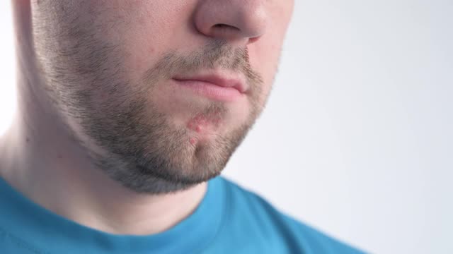 成人男士下巴痘痘霜。面部皮肤护理。视频下载