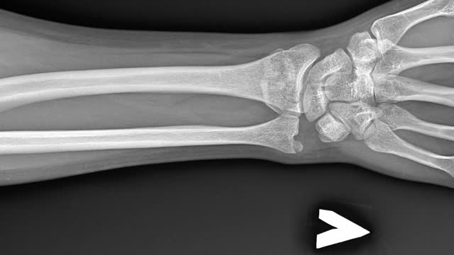骨折手臂的x光片。人体解剖学，骨骼移位损伤的图像视频素材