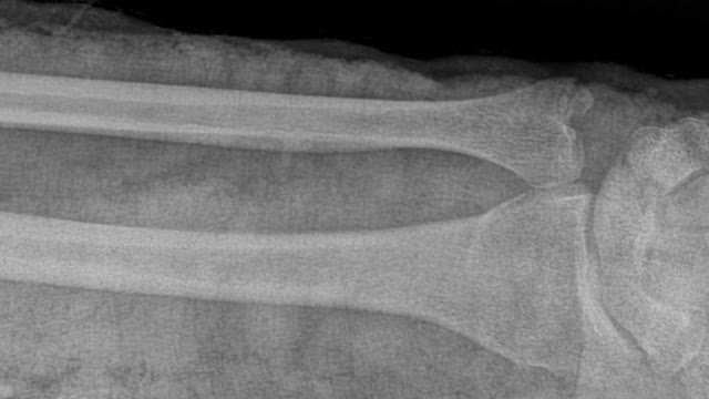 桡骨和尺骨骨折移位- x光片。人的断手视频素材