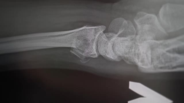桡骨骨折移位的x光片。医生正在研究受伤的骨头。放射科医生在诊所做出了4k的诊断视频素材