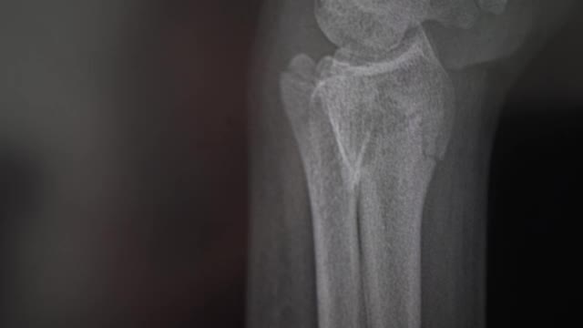 臂骨x光片。放射科医生检查了4k视频素材