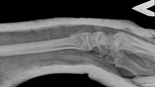 骨复位后的手x光片。这是创伤外科医生手术后用石膏包扎的骨折手臂的照片视频素材