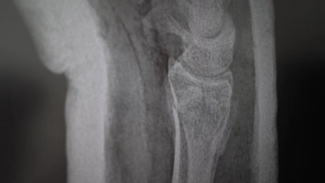 石膏中骨折手臂的x光片。医生给病人看伤口的位置。一张人类骨骼的照片，4k视频素材
