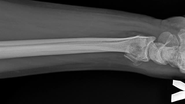 运动中骨折的人的x光照片。骨架结构视频素材