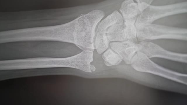骨折手臂的x光片。医院的医生指向骨折现场，近距离镜头4k视频素材