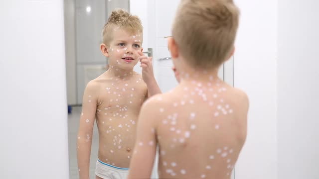 小男孩在镜子前审视自己。水痘病毒或水痘泡疹的儿童视频下载