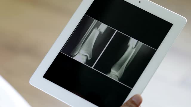 医生用数码片对骨折骨进行x光检查视频下载