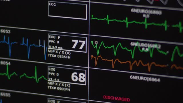 电脑心脏监测器屏幕显示了几个病人的心电图心率和医疗统计数据。视频素材