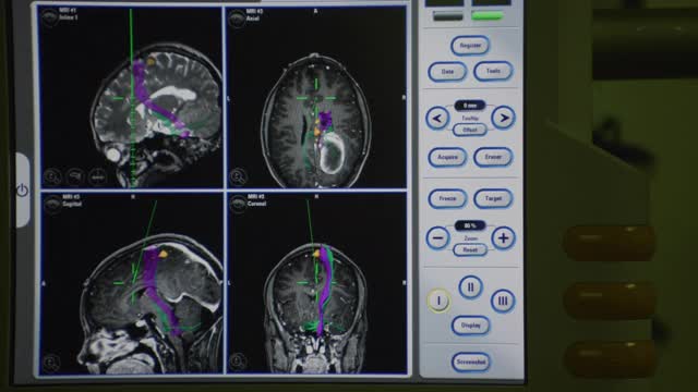 四四个面板视图与MRI计算机图像说明了一个人类脑肿瘤与彩色图形和技术信息。视频下载