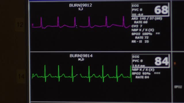 电脑心脏监测器屏幕显示了几个病人的心电图心率和医疗统计数据。视频素材