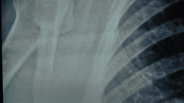 胸部x光片全景微距拍摄。哮喘、COVID-19、冠状病毒或肺炎诊断概念视频下载